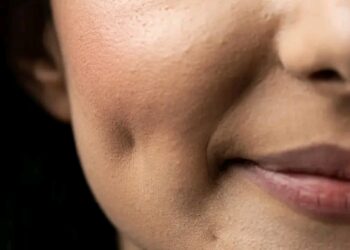 Shin Dimple Naƙasa Ne Ko Kyau? Ga Gaskiyar Da Ba Kowa Ya Sani Ba