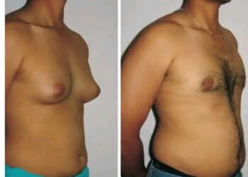 Abin Mamaki! Abunda Yake Janyo Nono Ya Fito Wa Namiji Kamar Na Mace: Ga Dalilai 8 Dake Kawo Su 👇