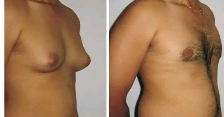 Abin Mamaki! Abunda Yake Janyo Nono Ya Fito Wa Namiji Kamar Na Mace: Ga Dalilai 8 Dake Kawo Su 👇